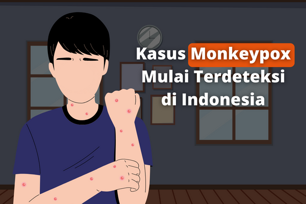 Kasus Monkeypox Mulai Terdeteksi di Indonesia